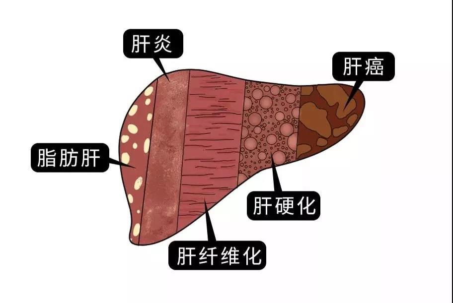 脂肪肝的最大敵人不是肥胖，答案竟是這樣！