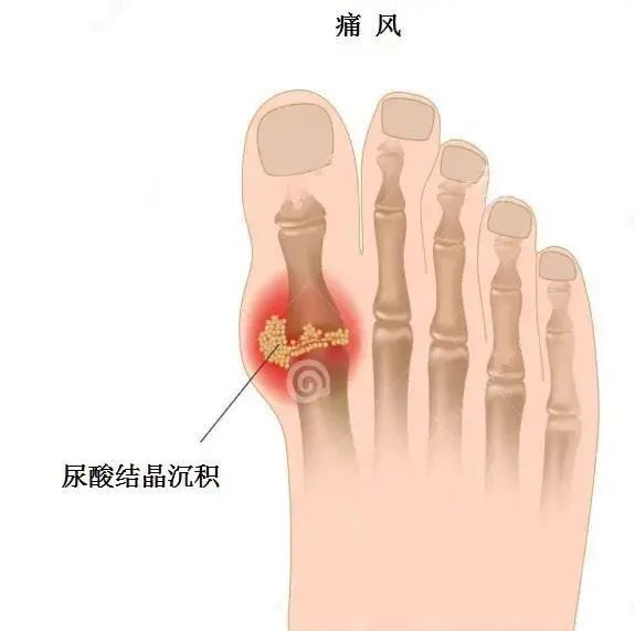 痛風(fēng)為什么偏愛男性？你最關(guān)心的問(wèn)題都在這里