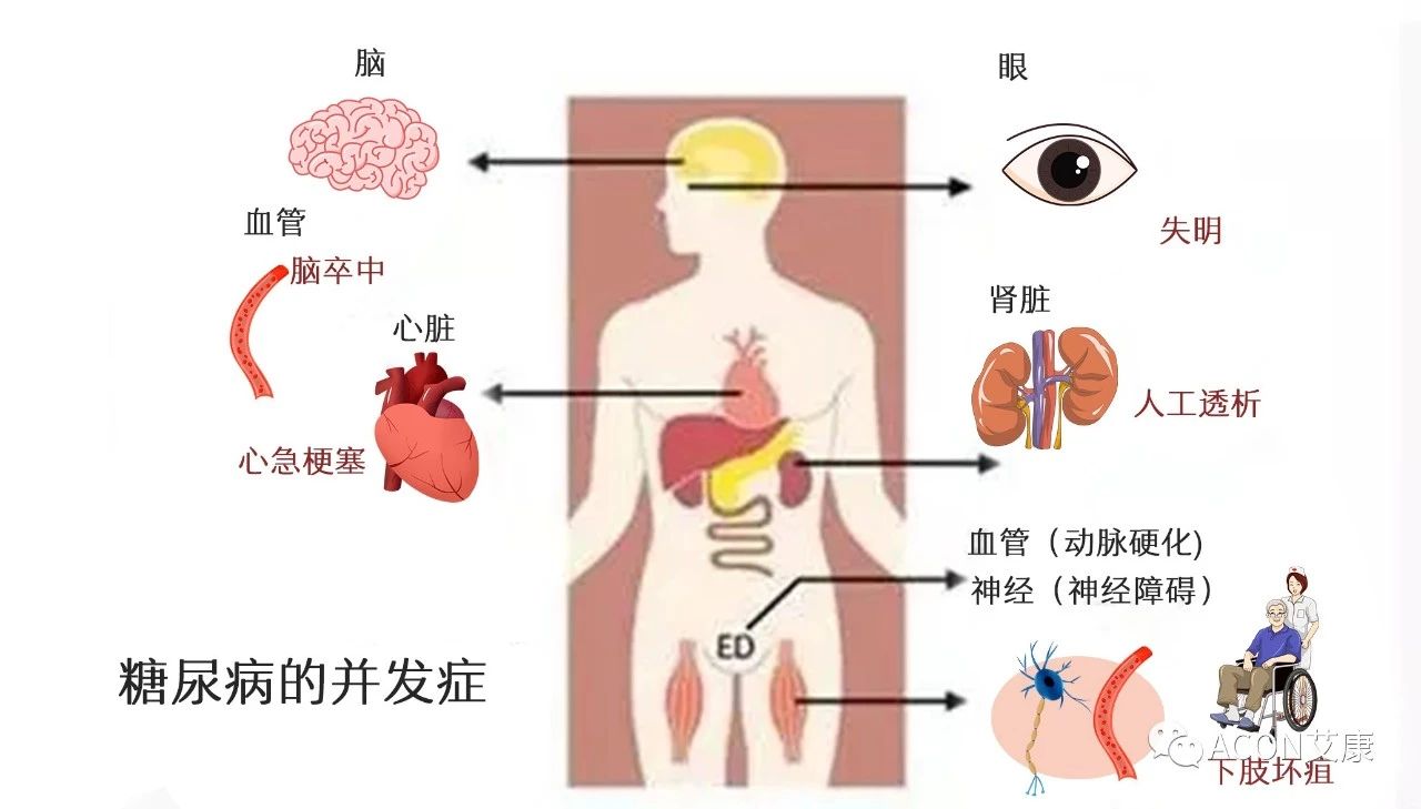 爆上熱搜，因爆發(fā)型糖尿病進(jìn)入ICU，有哪些教訓(xùn)值得我們汲取