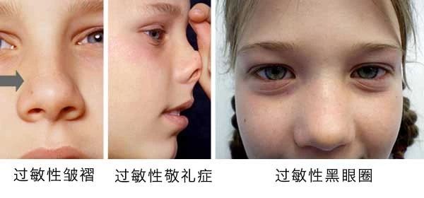 過敏性鼻炎會讓孩子變傻？！家長該如何應(yīng)對